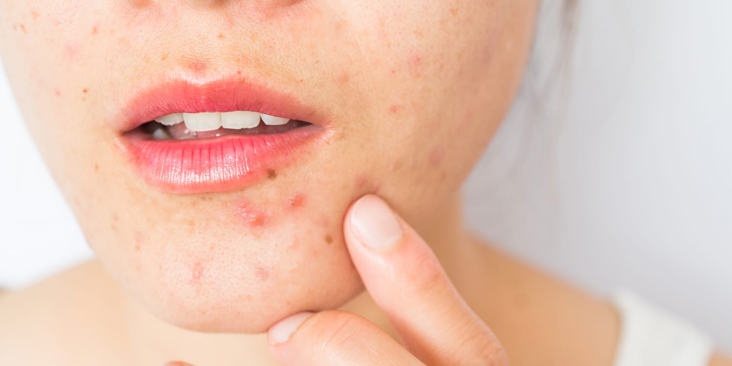 Cystic acne: Dermatologists explain causes and tips to treat it