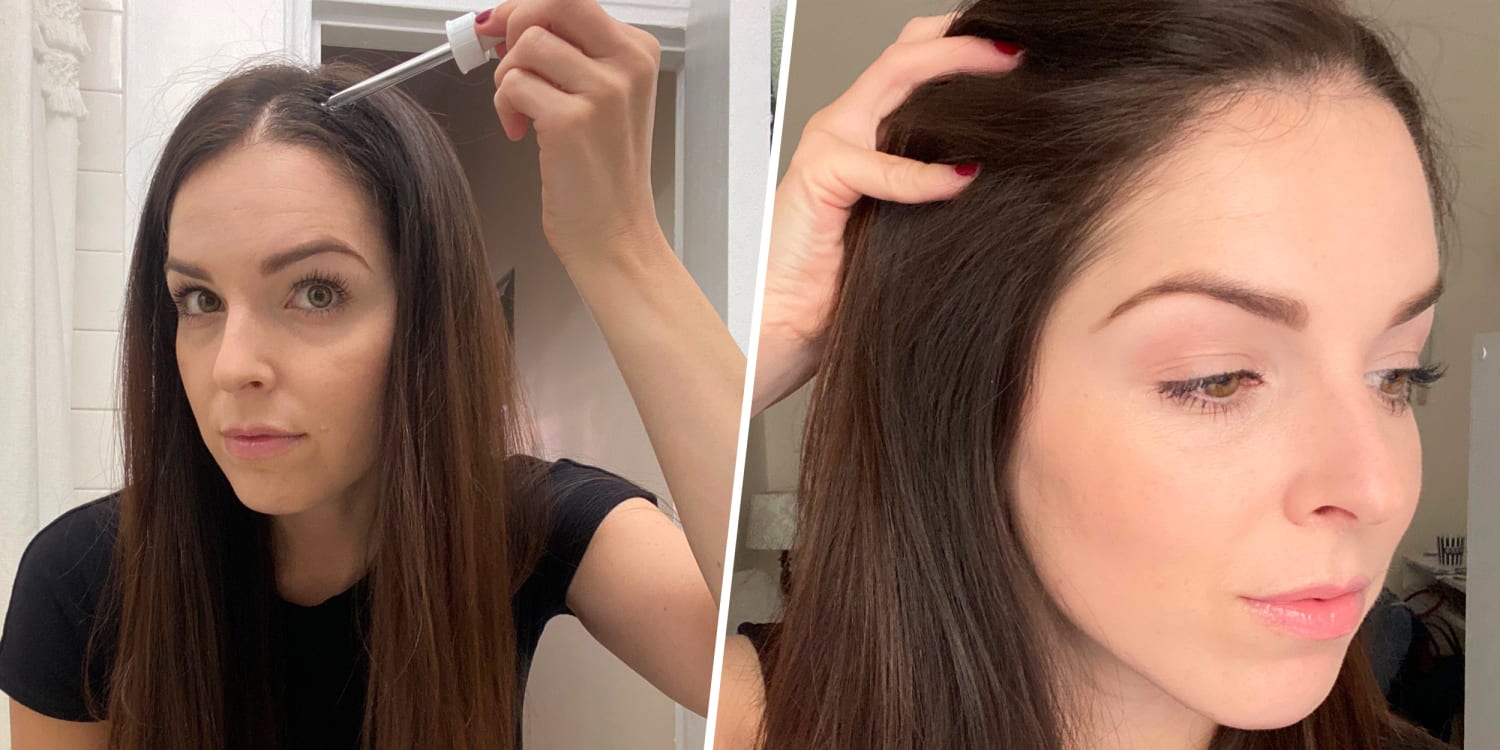 The Ordinary hair serum saved my scalp and improved growth