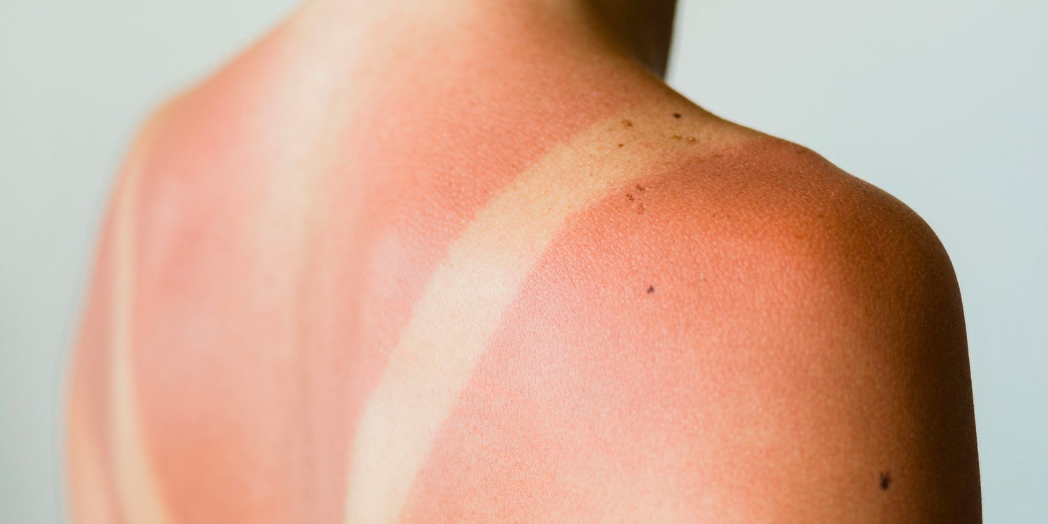 9 best sunburn of 2023 according dermatologists