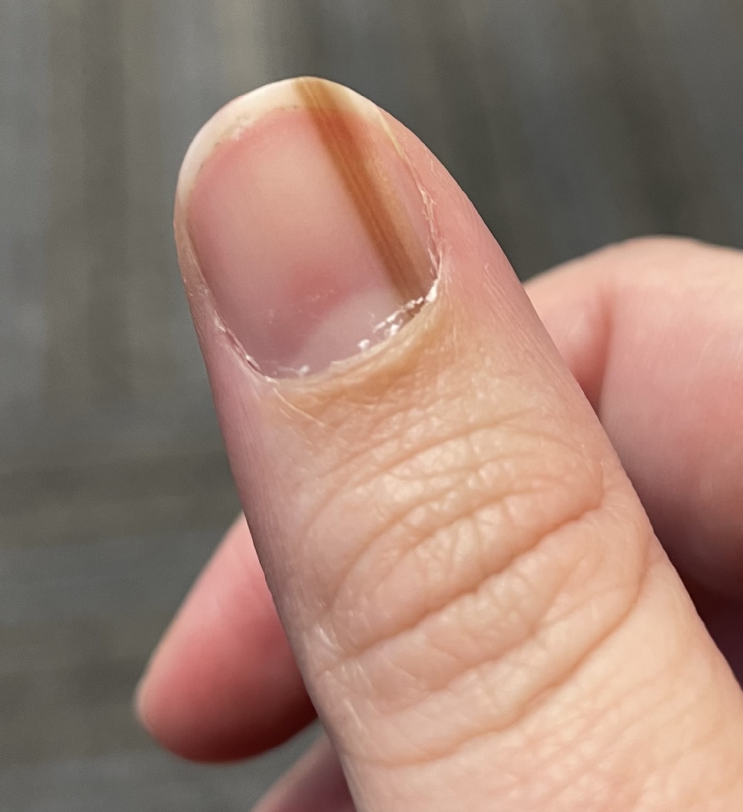 What Causes Fingernails to Split Down the Middle: A Comprehensive  Examination of the Causes - PharmEasy Blog