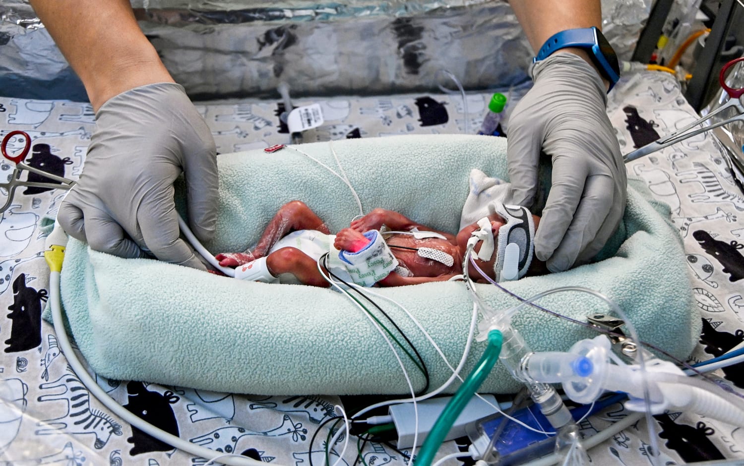 I'm a neonatologist. This is what happens when a baby is born 5 months  early.