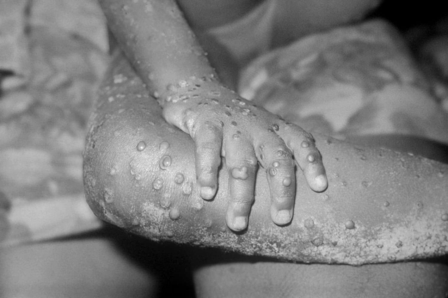 What to Do If You Think You Have Monkeypox Symptoms, According to Experts