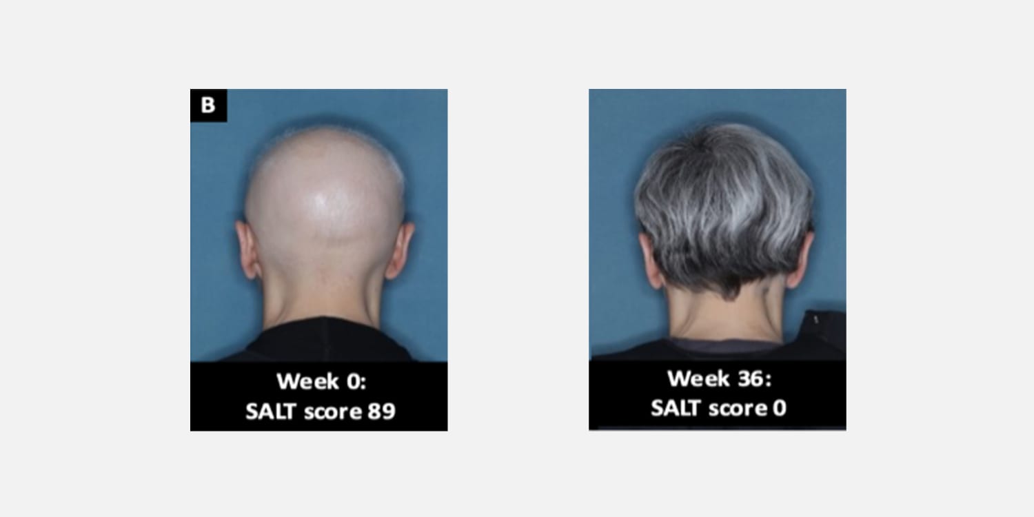 First alopecia treatment for autoimmune disorder that causes sudden hair  loss approved by the FDA