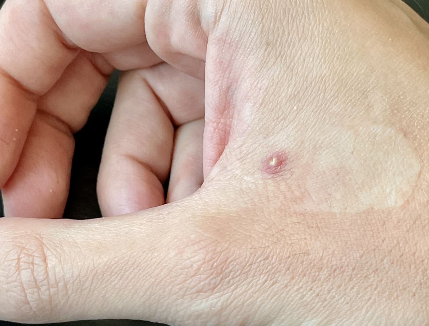 Monkeypox patient details symptoms: 'Worst pain I've ever experienced