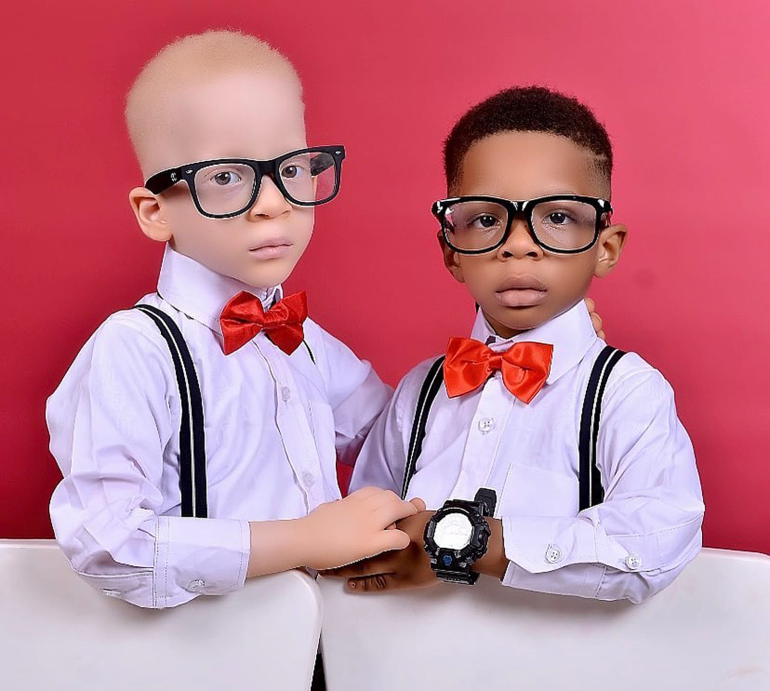 Twins - One With Albinism, One Without - Are Best Friends