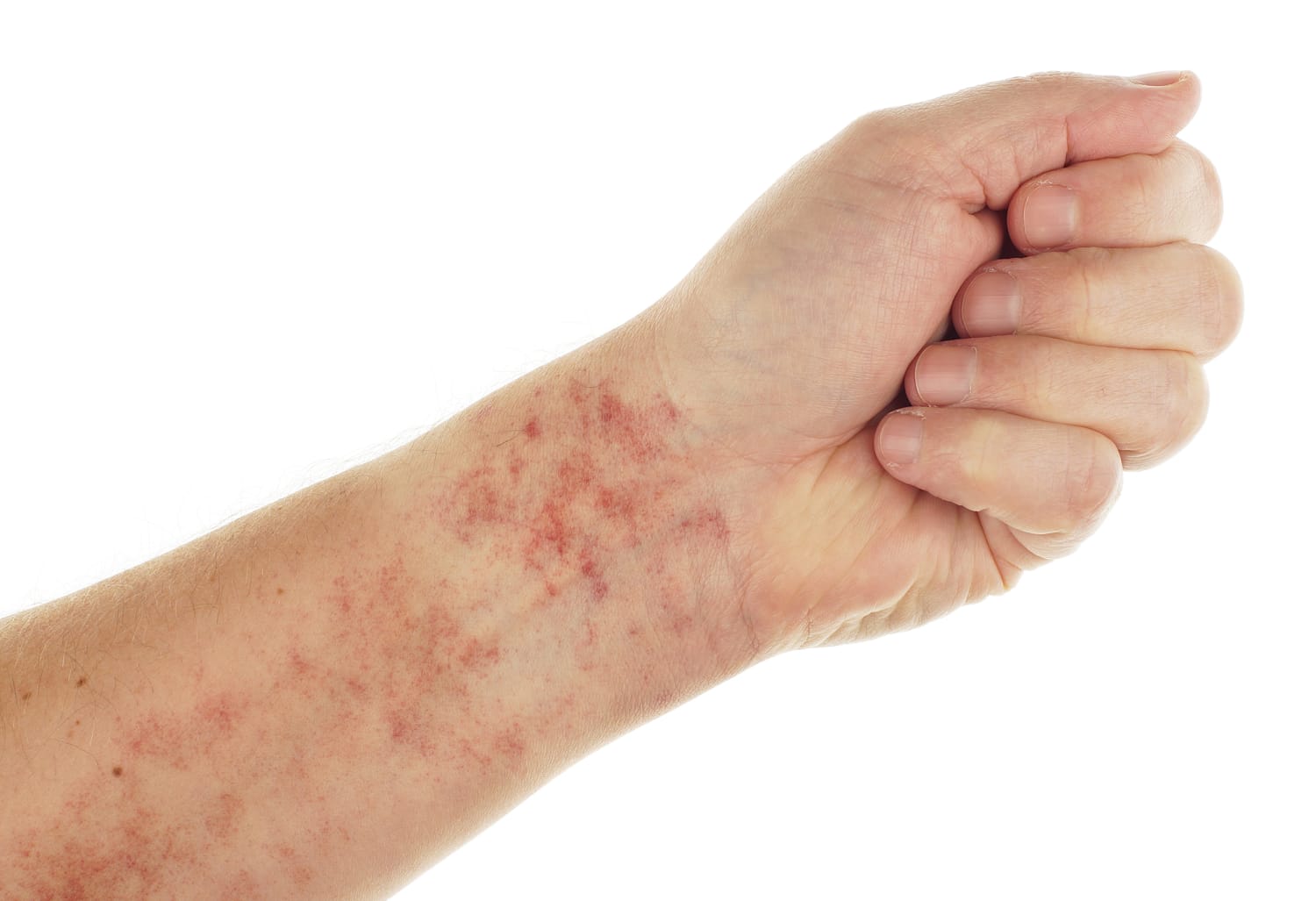 Skin irritation arm hi-res stock photography and images - Page 2
