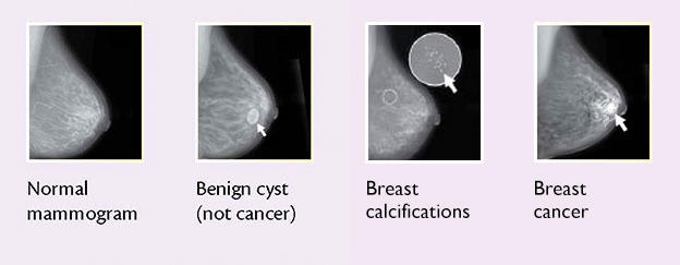 Feel For Yourself: Breast Lump Display