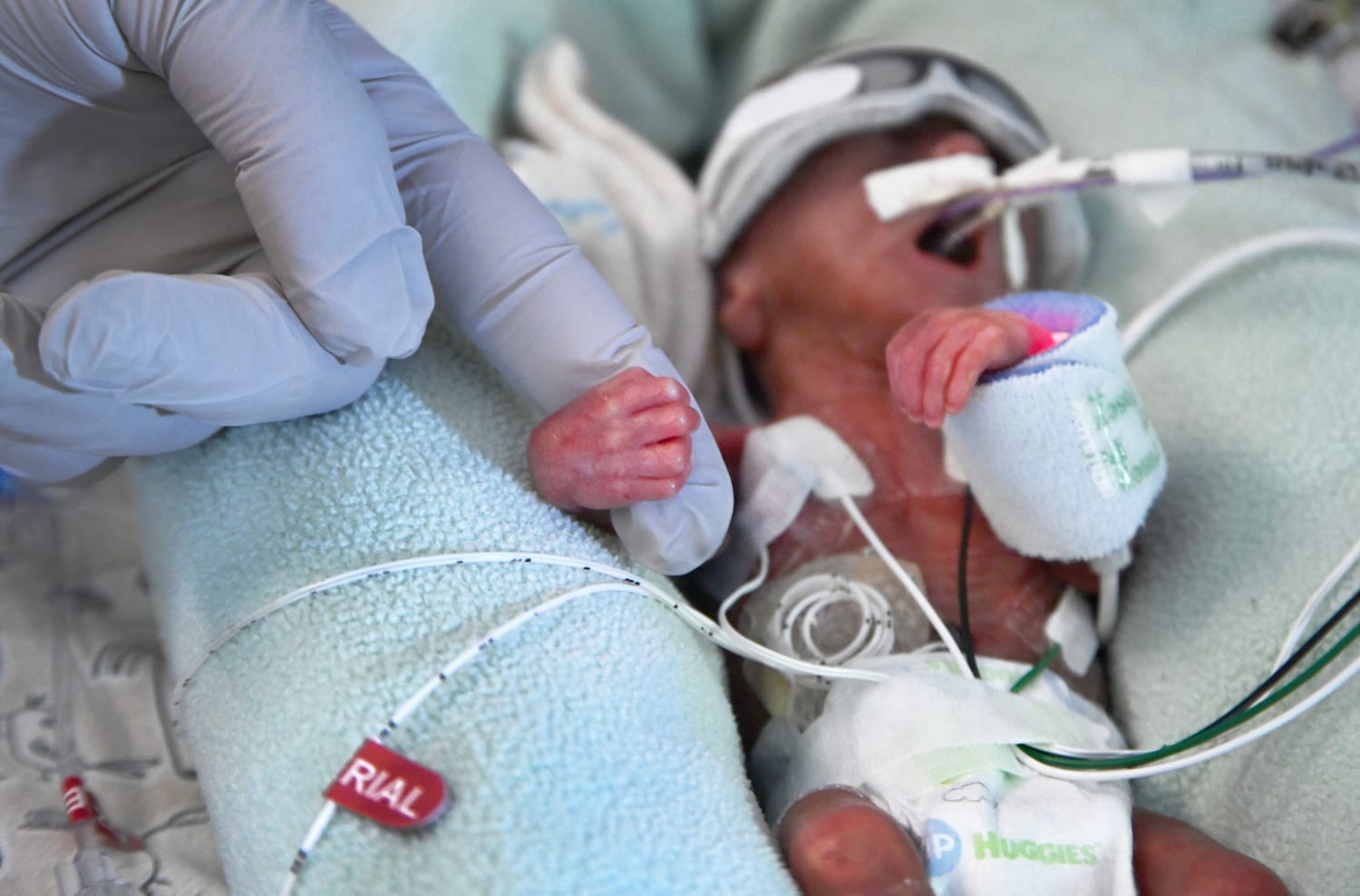 Premature births at an all-time high in the U.S., March of Dimes report finds
