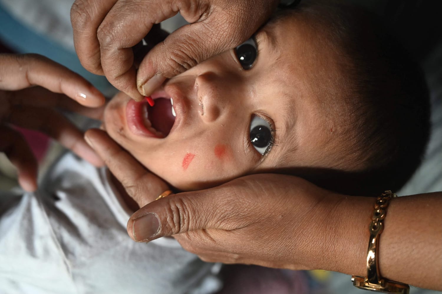 Measles is now an imminent global threat, WHO and CDC say in a new report