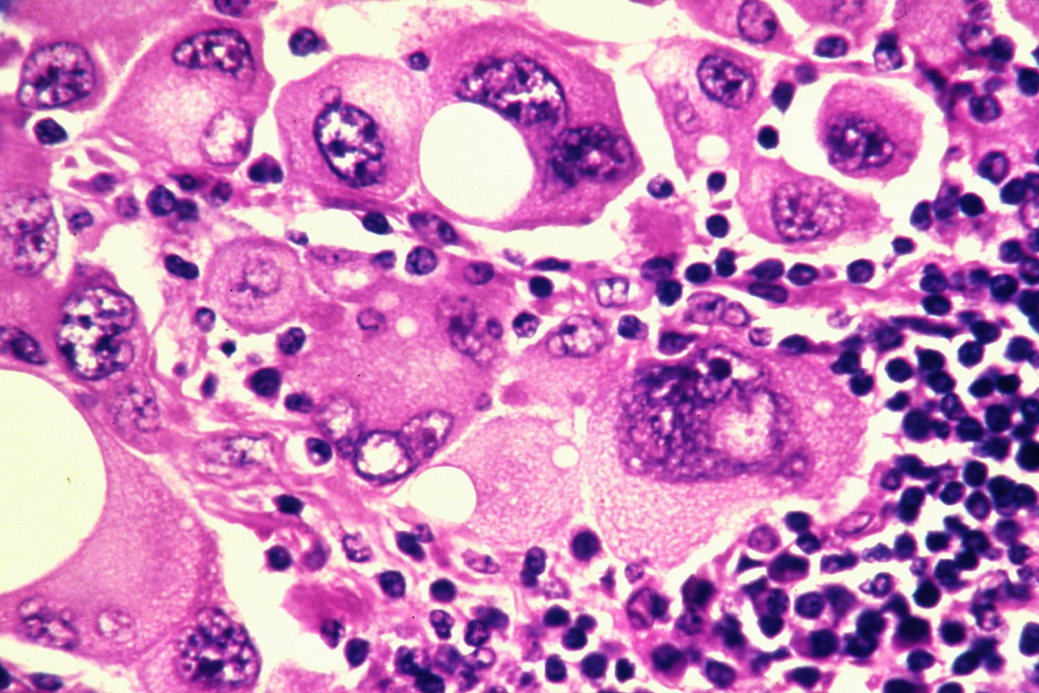 https://www.nbcnews.com/health/cancer/mrna-vaccine-melanoma-reduces-relapse-therapy-trial-shows-rcna79543 social preview image