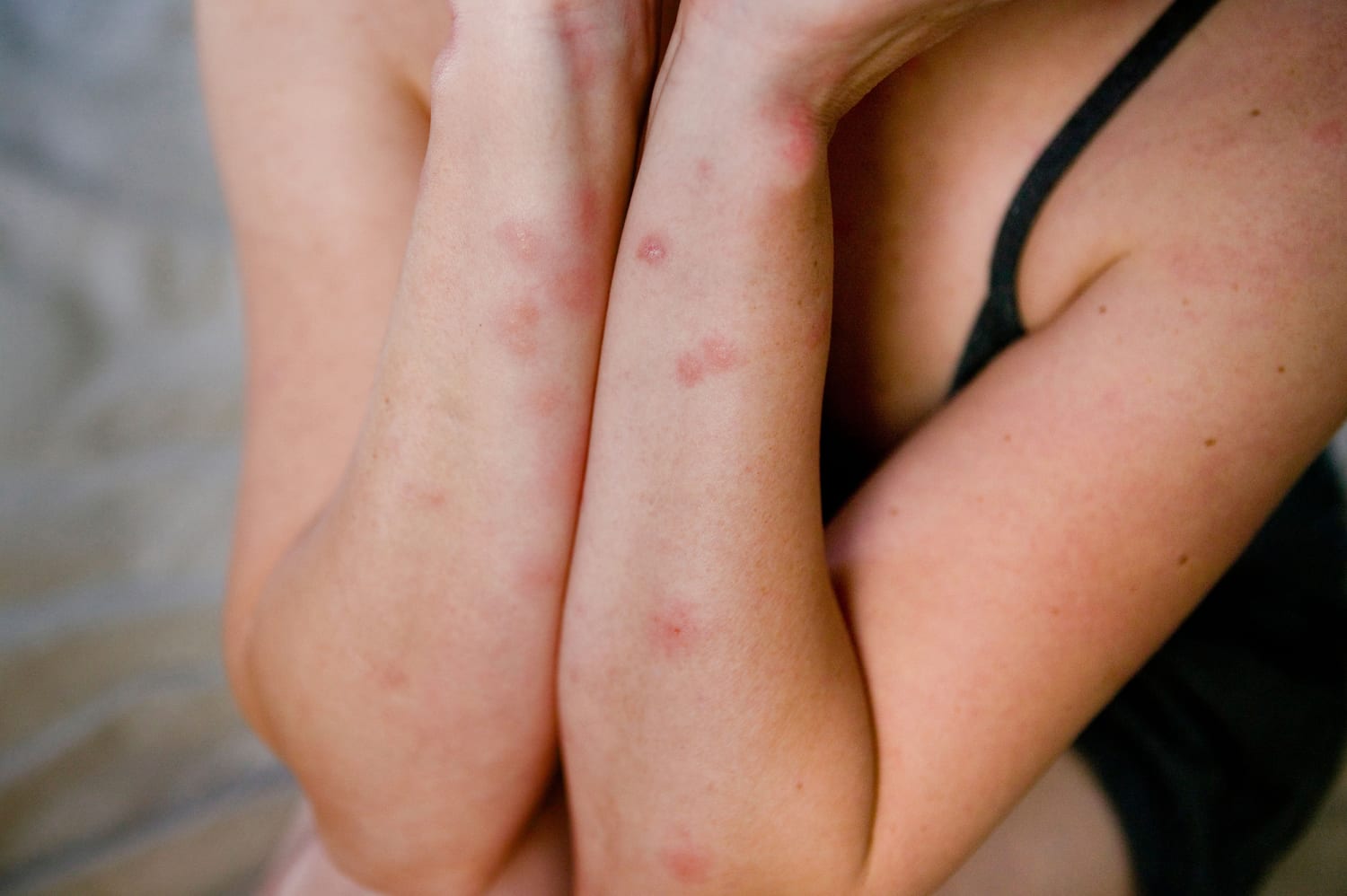 Mosquito Bites On Skin Under Breast Stock Photo 1831982848