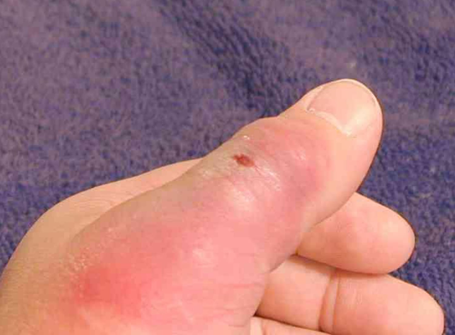 Violin Spider Bite On Hand - Fact or Fiction?
