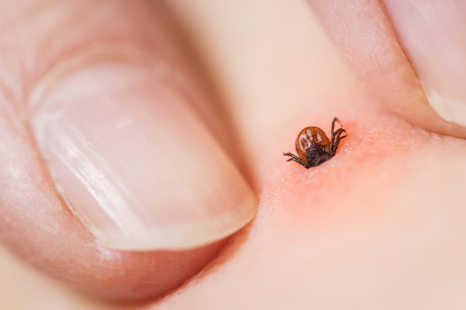 Tick Bite Symptoms to Know, According to Experts
