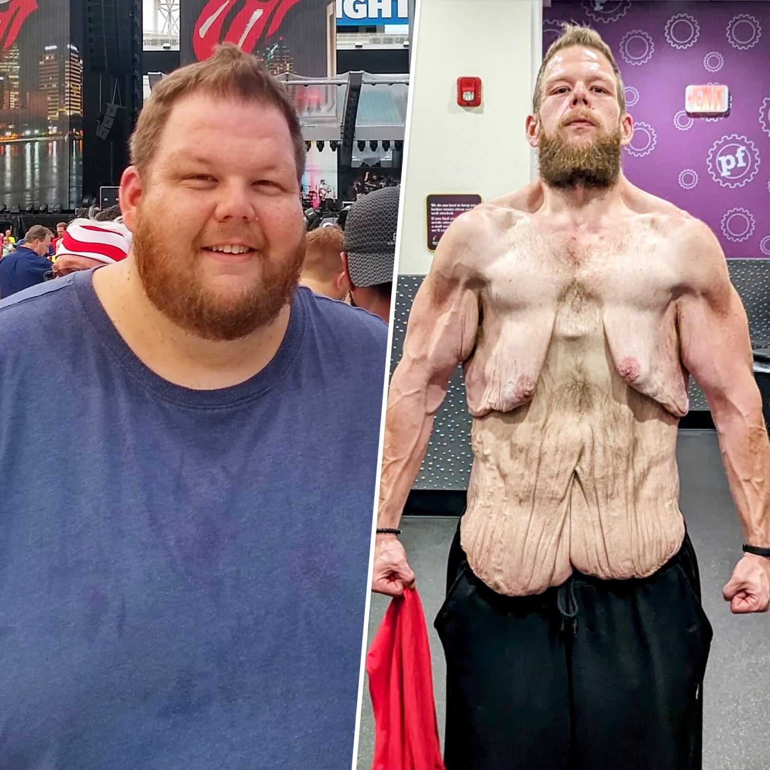 Man Loses 360 Pounds By Walking Seeks Help For Loose Skin