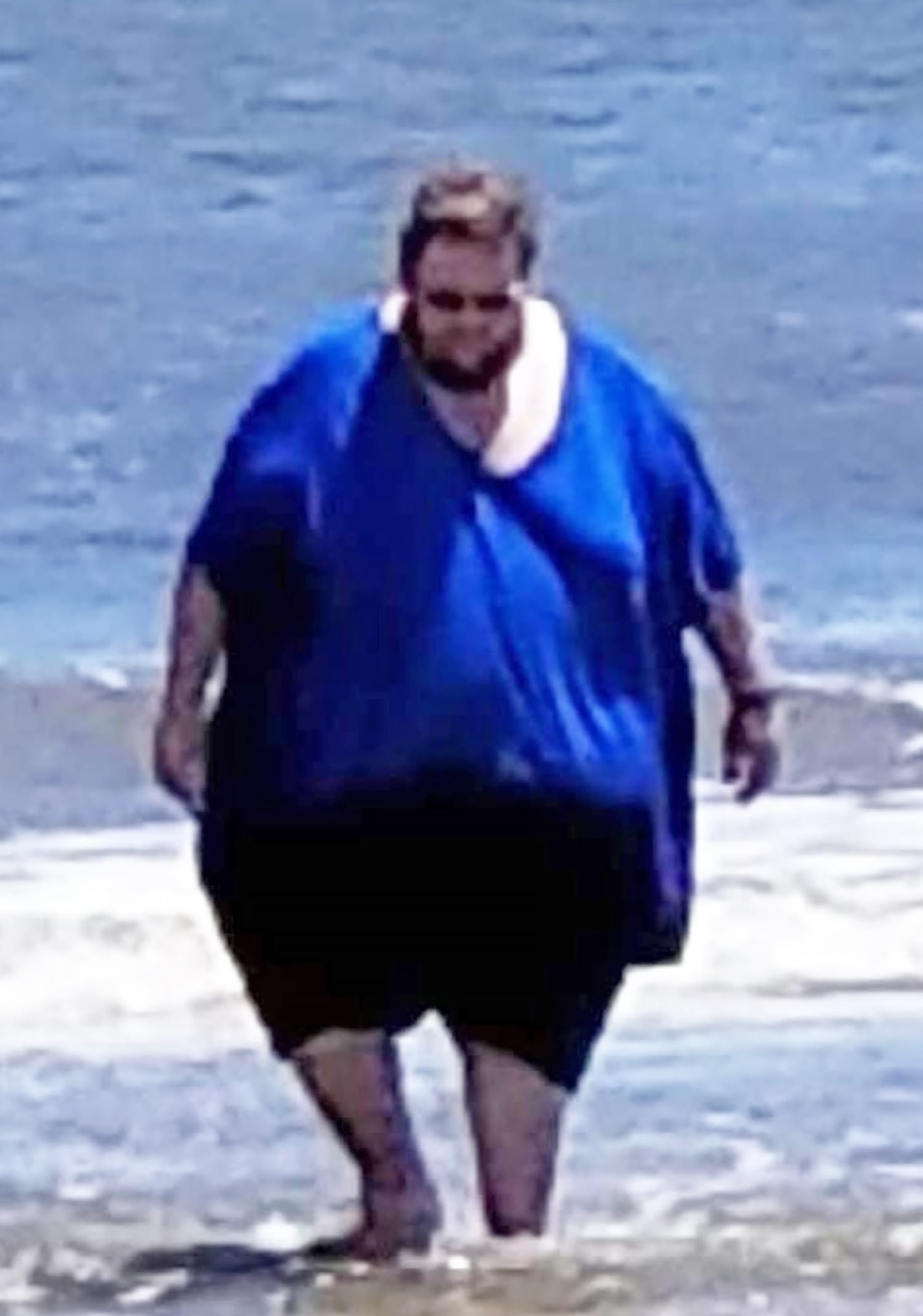Man Loses 360 Pounds By Walking, Seeks Help For Loose Skin