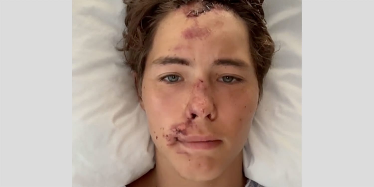 TikTok star Caleb Coffee hospitalized after fall off 80-foot Hawaii cliff, family says