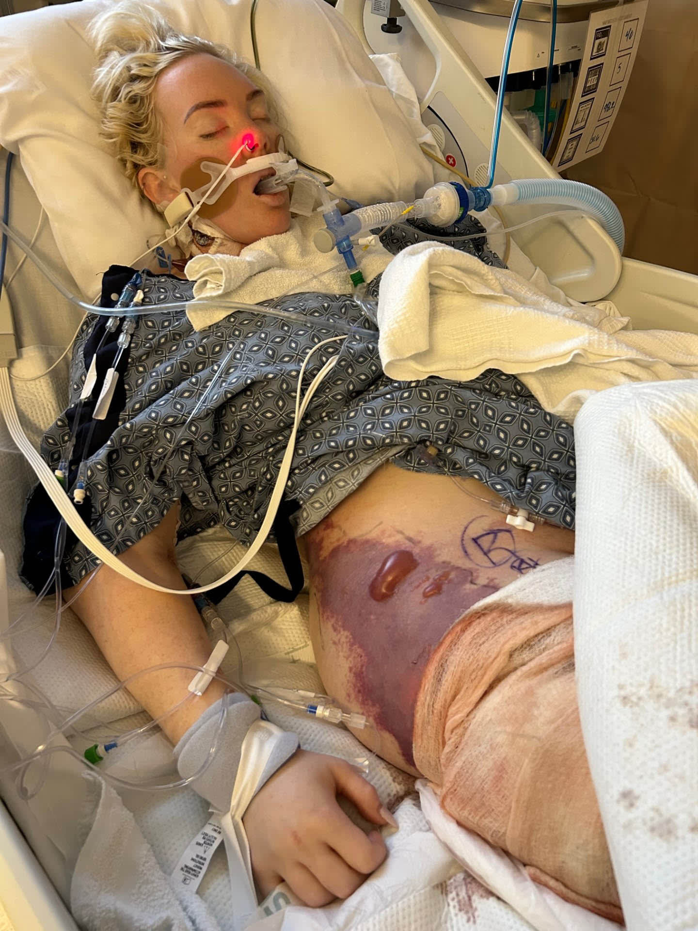 California Mom Loses All Her Limbs From Bacterial Infection