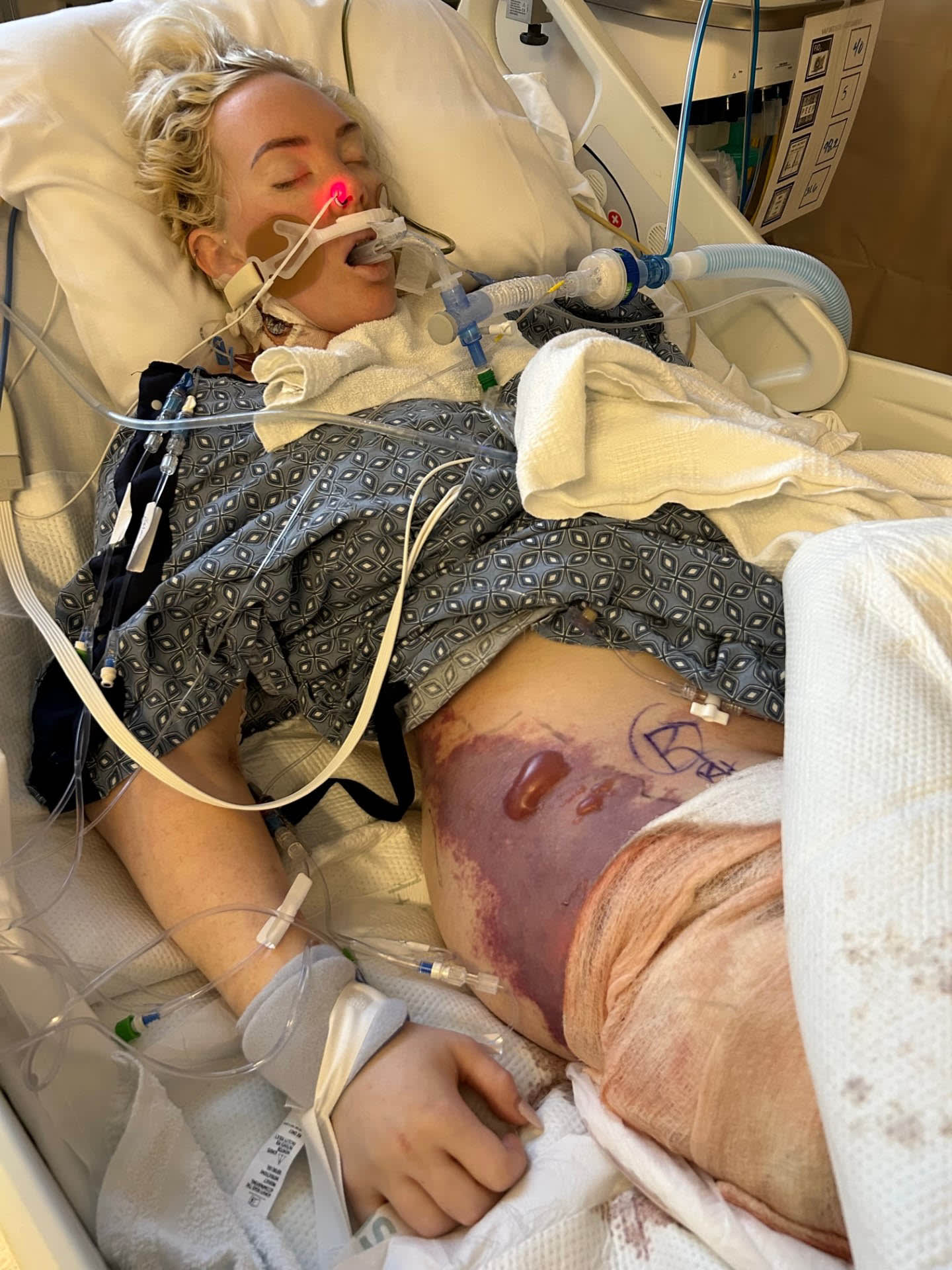 California mum has her arms and legs amputated after eating