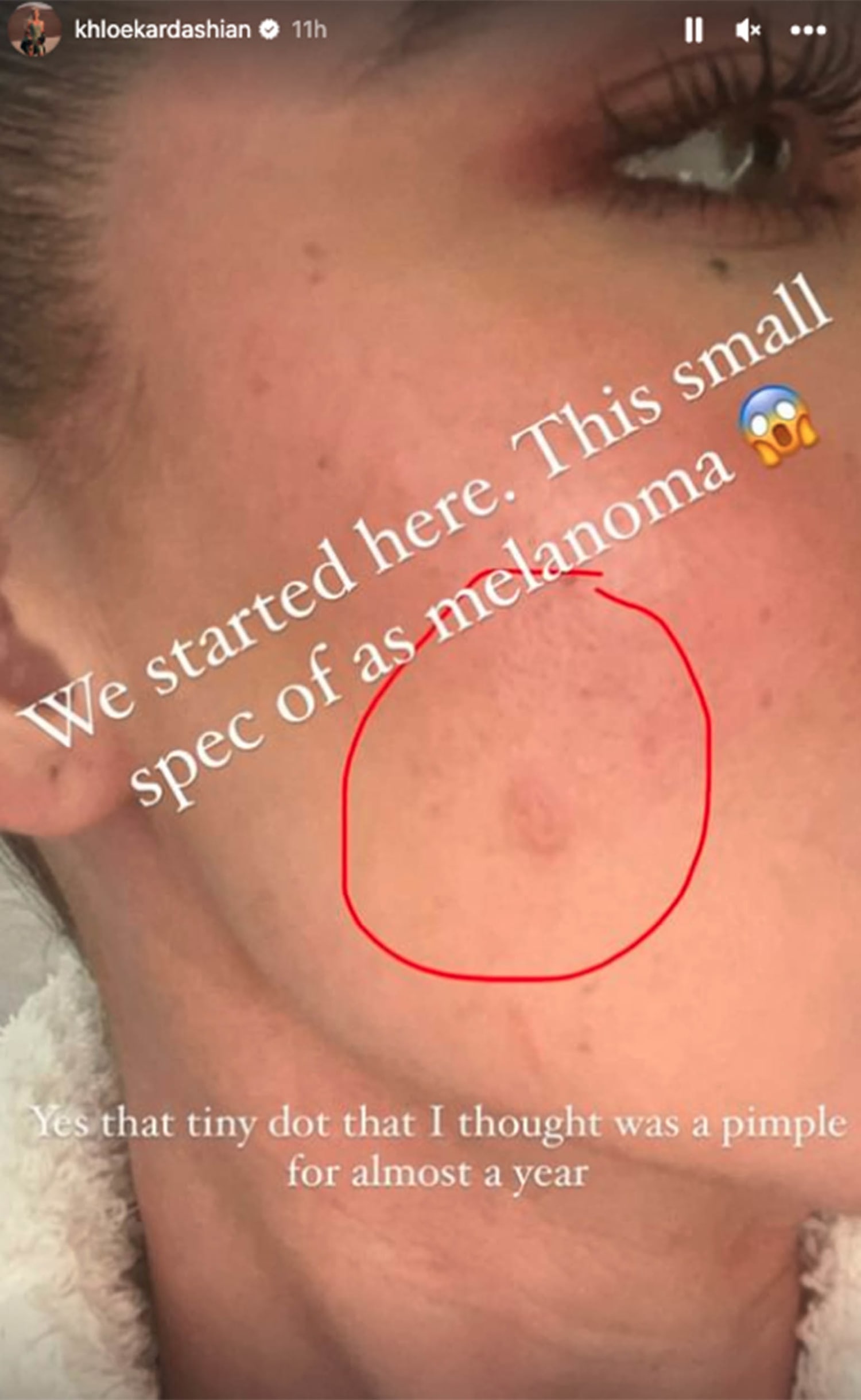 Khloé Kardashian Details Melanoma Tumor Removal From Face With Pics