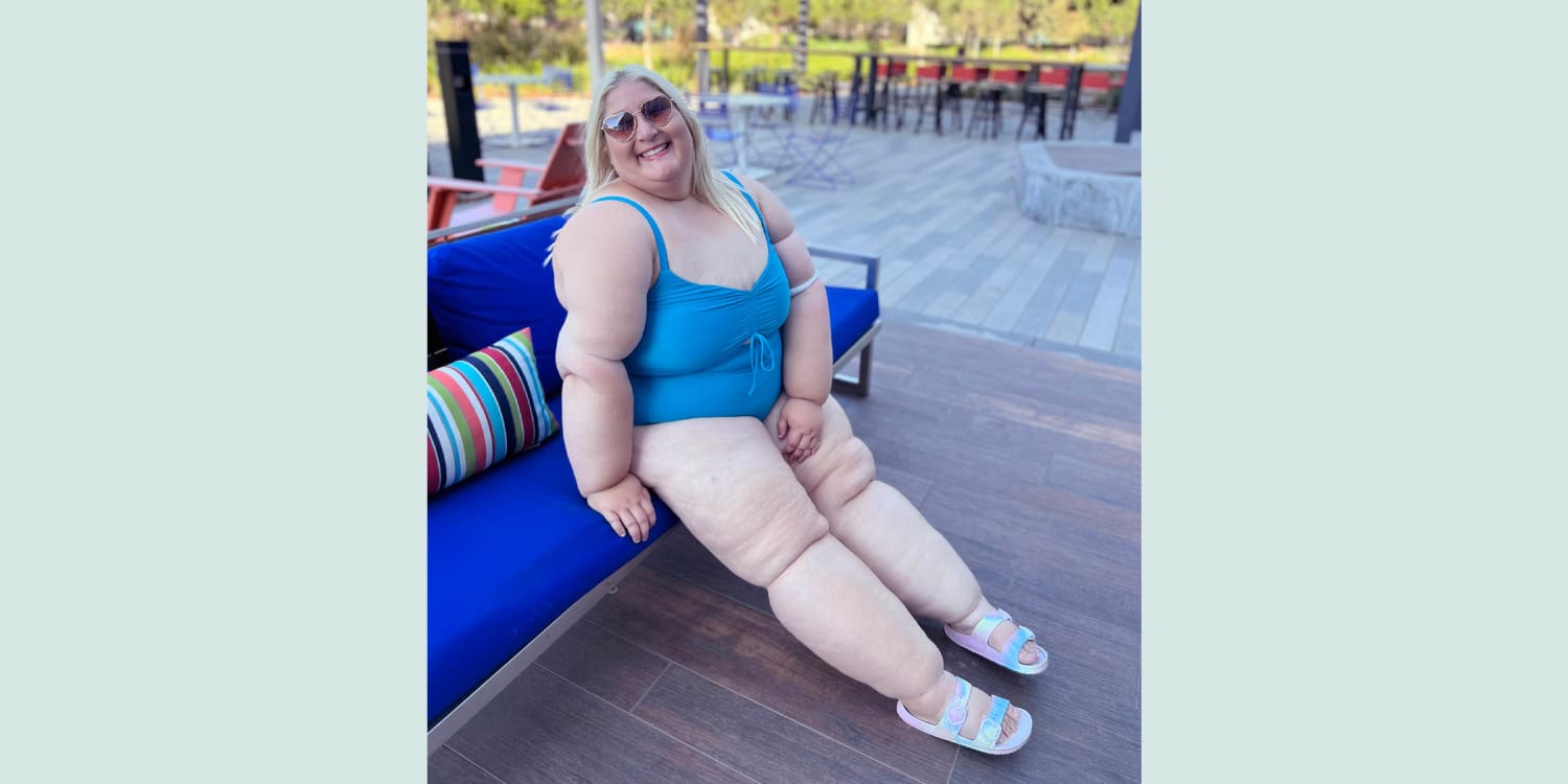 She Lost 350 Pounds. Her legs Were Still Big. She Had Lipedema