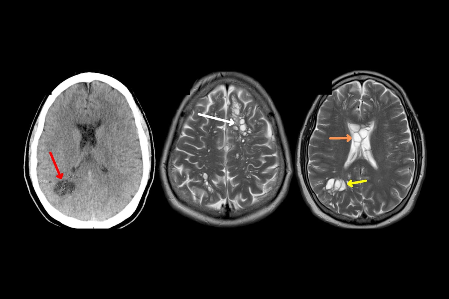 Man ontdekt migraine veroorzaakt door lintwormen in de hersenen;  Niet gaar spek kan de boosdoener zijn