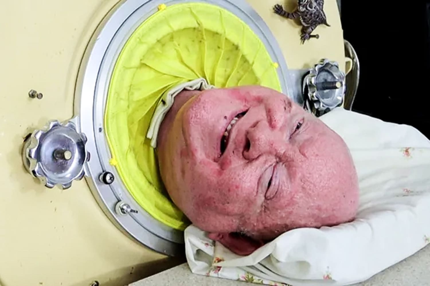 Paul Alexander, polio survivor in iron lung for over 70 years ...