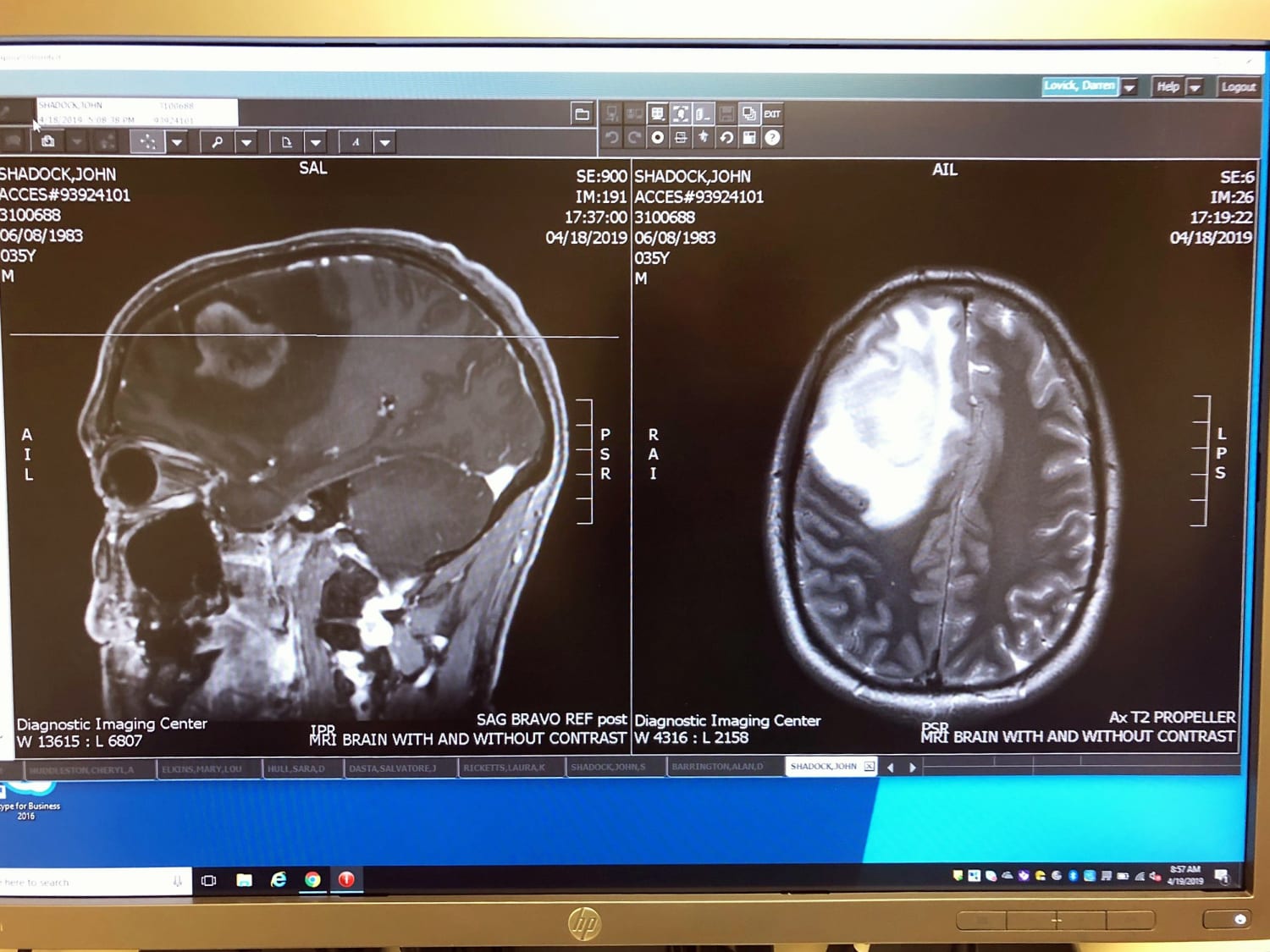 Man, 20, Diagnosed With Glioblastoma Brain Cancer After 20 Symptom