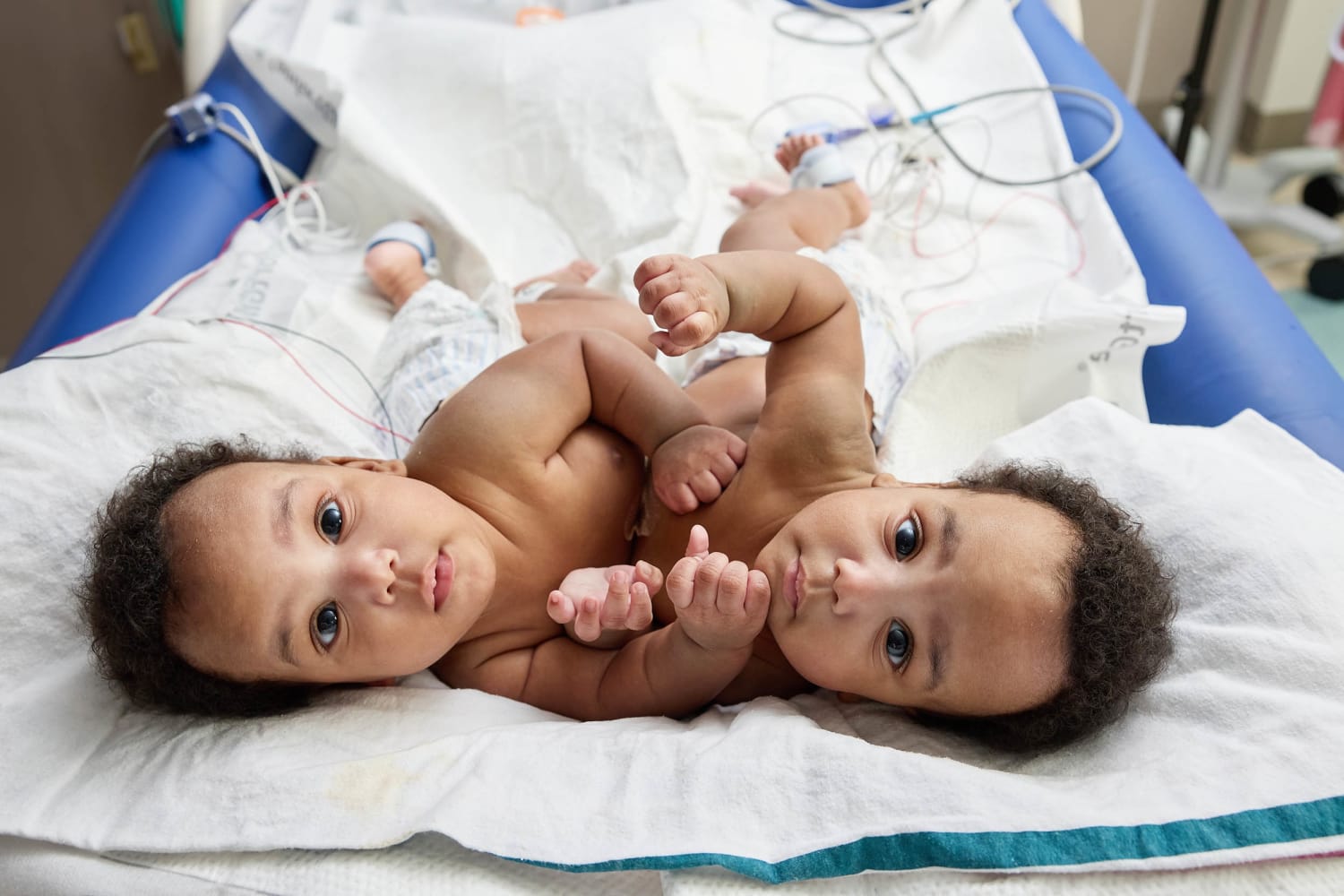 Conjoined twins who were separated at 11 months old go home from hospital