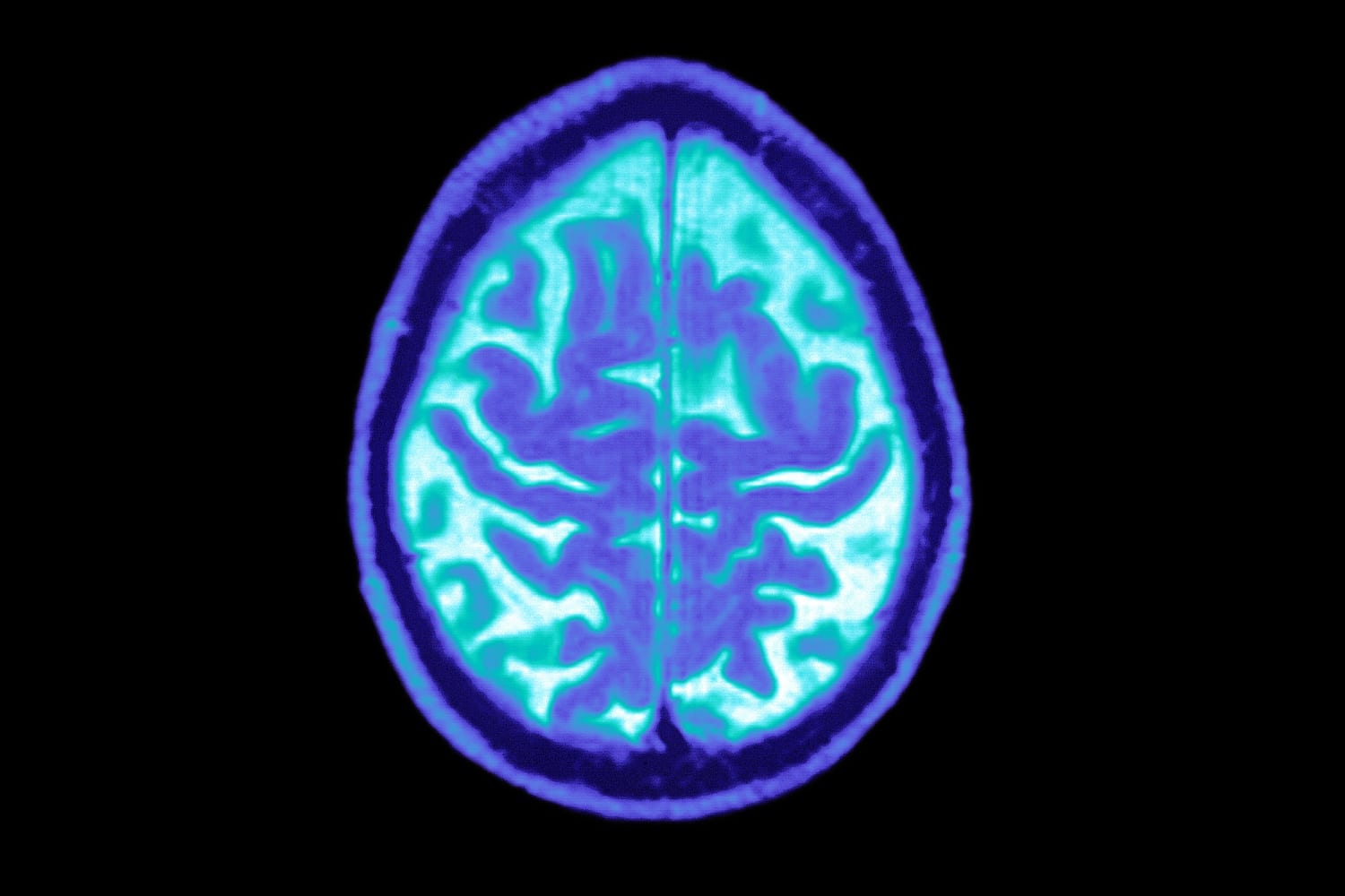 Novo Nordisk still sees potential for GLP-1 drugs for Alzheimer's, despite  trial setback