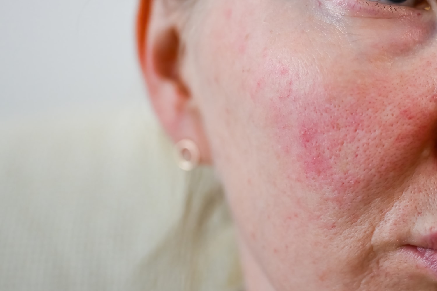 How to Prevent and Treat Rosacea Flare-Ups, According to Dermatologists