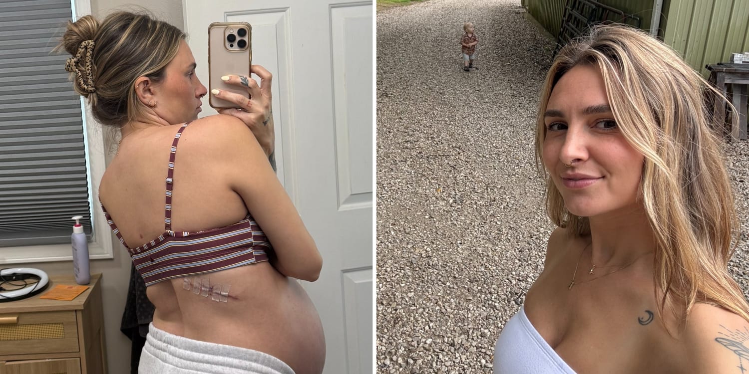 Pregnant Mom, 33, Diagnosed with Melanoma Faced ‘Scary’ Surgery Before Delivering Baby