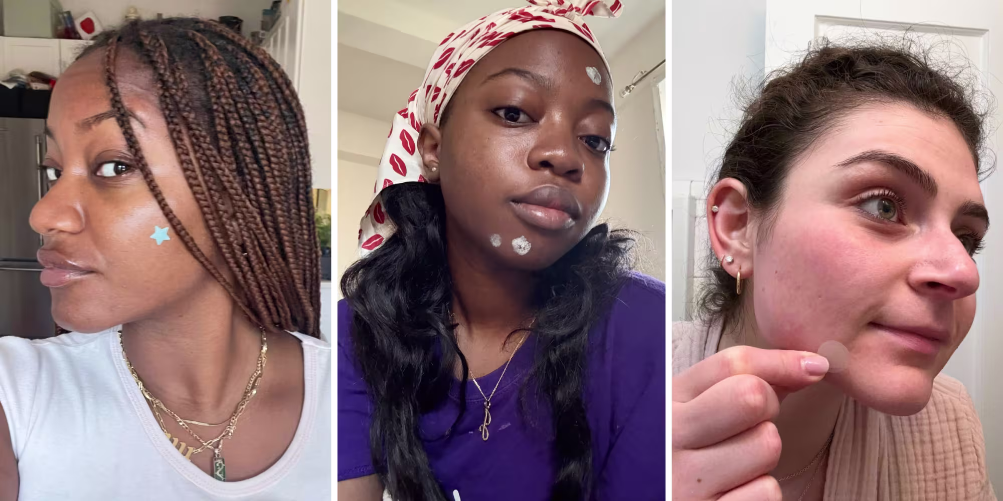  We tried several different acne spot treatments, including gels, pimple patches and creams, so you don’t have to.  Courresy Ashley Morris; Courtesy Jem Alabi; Courtesy Zoe Malin