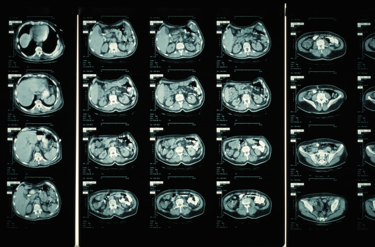 What is a CT scan? What the test detects and how