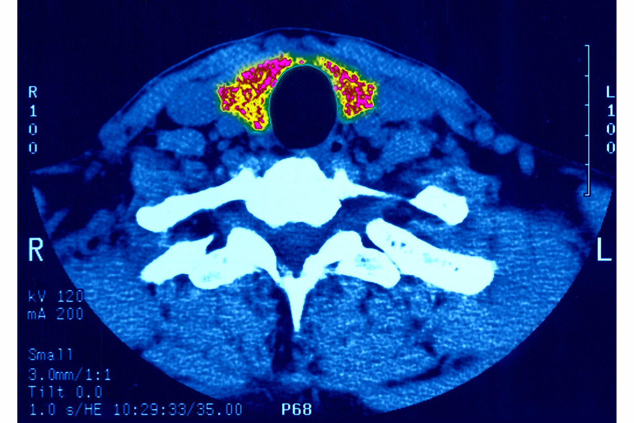 Study Finds Thyroid Cancer Diagnoses Rise, But Treatment May Not 