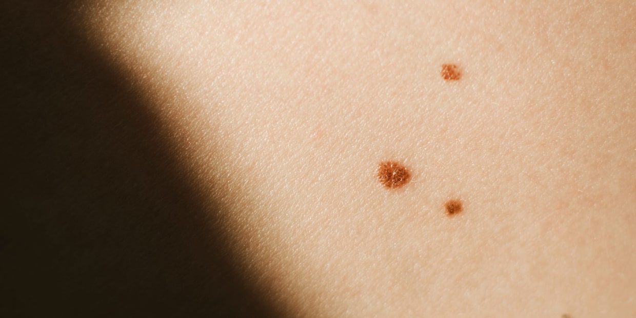 Melanoma Skin Disorder Causes Pictures Symptoms Today