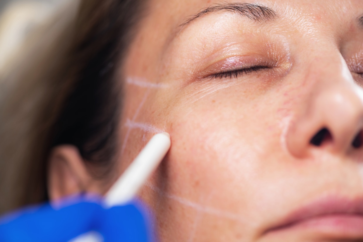 Overview of Different Thread Types at Skin Renewal Clinics