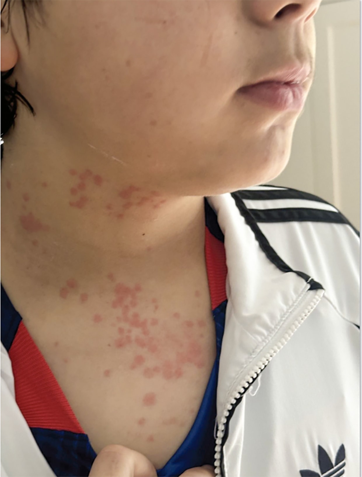 One of the Albuquerque children with suspected bed bug bites visible on his neck and chest.