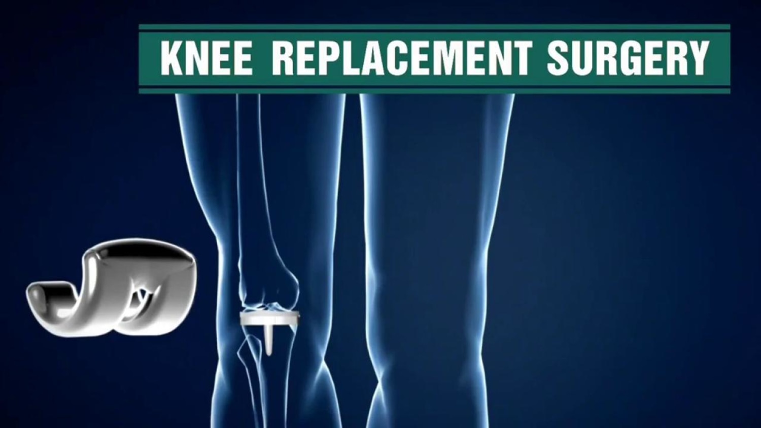 Out Of Joint When Knee Replacements Bring Pain And Regret