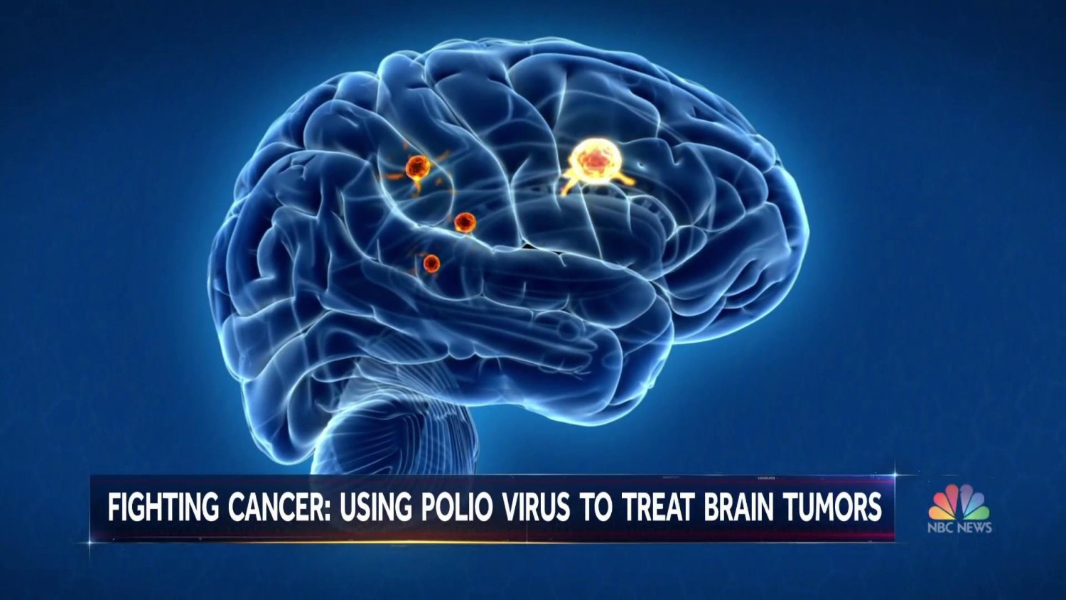 Modified polio vaccine helps fight deadly brain tumors