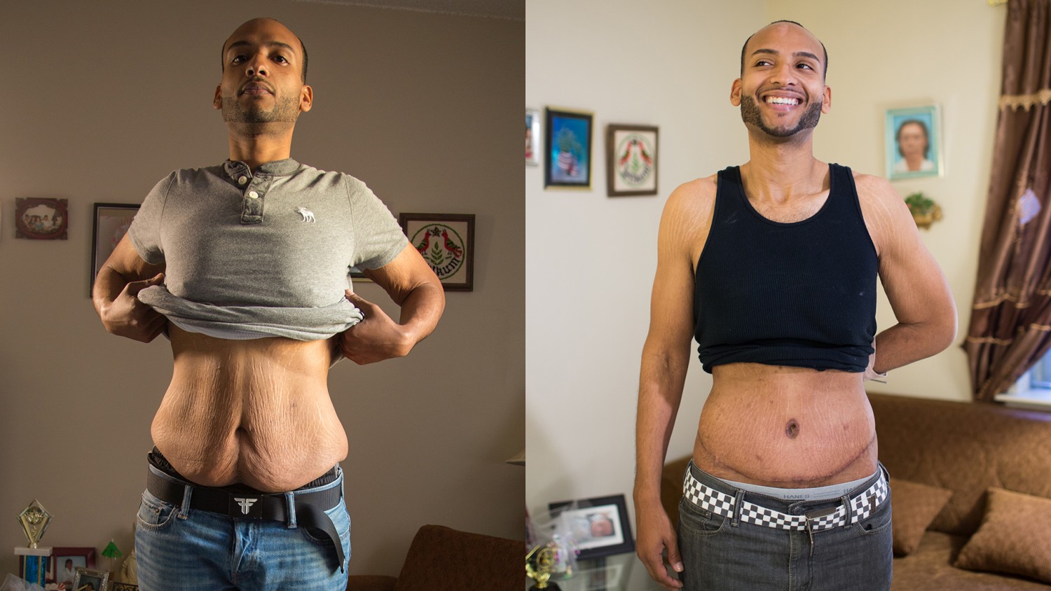 After Huge Weight Loss, Sagging Skin Remains