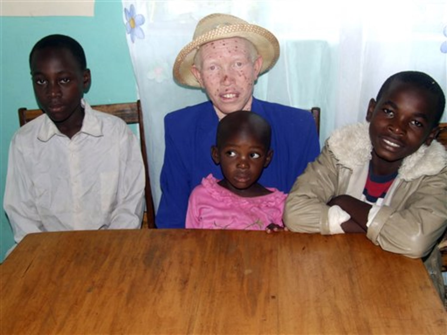 Albinos in East Africa fear for lives after killings