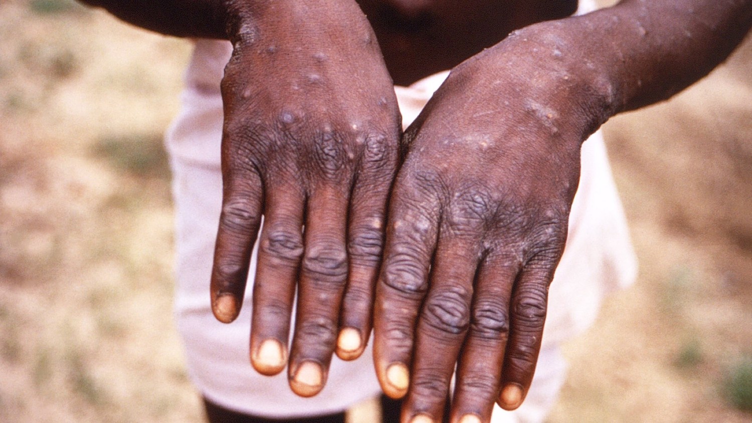 Monkeypox symptoms: Here's what scientists are learning : Goats and Soda :  NPR