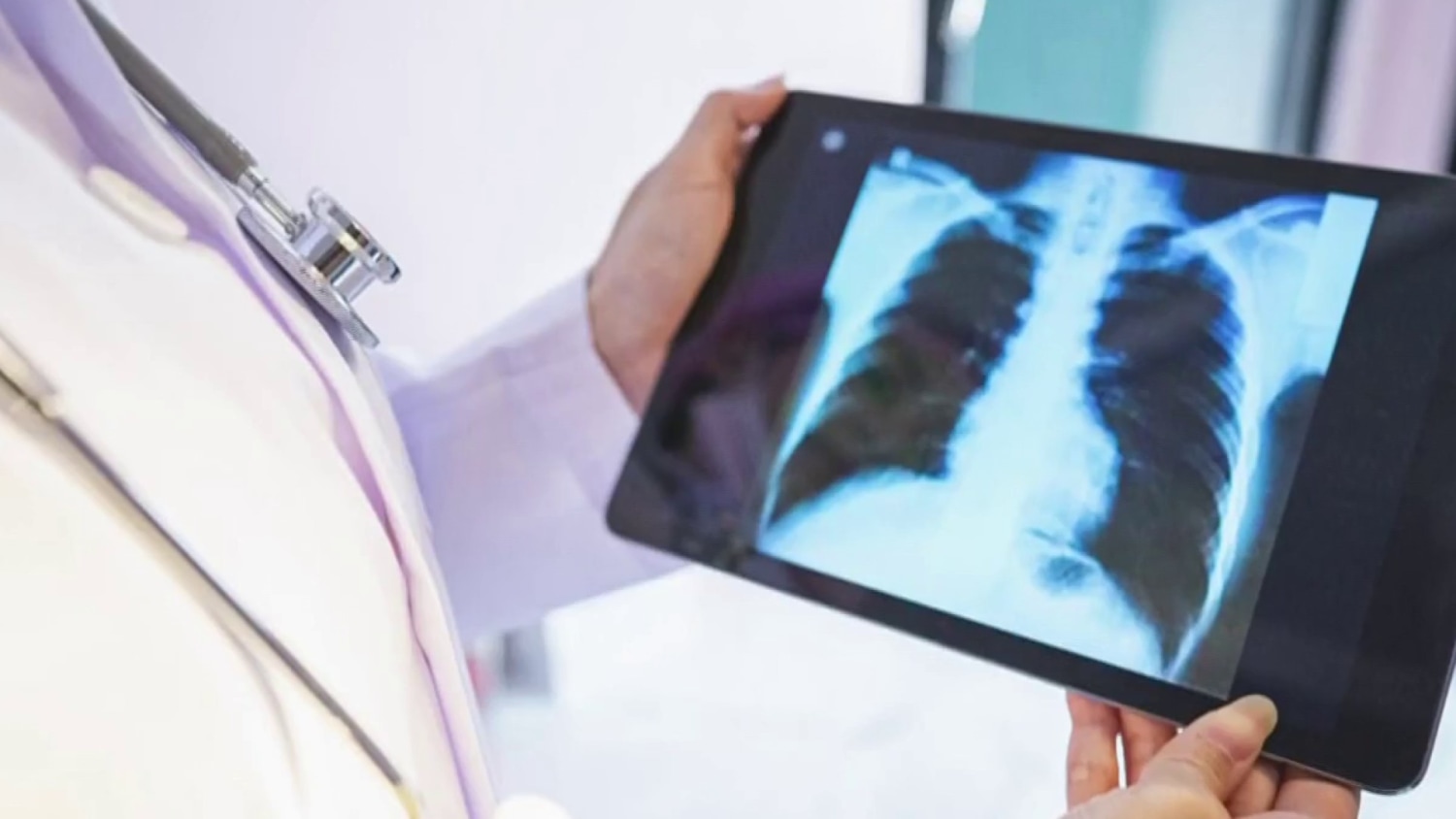 Promising new AI can detect early signs of lung cancer that doctors can't  see