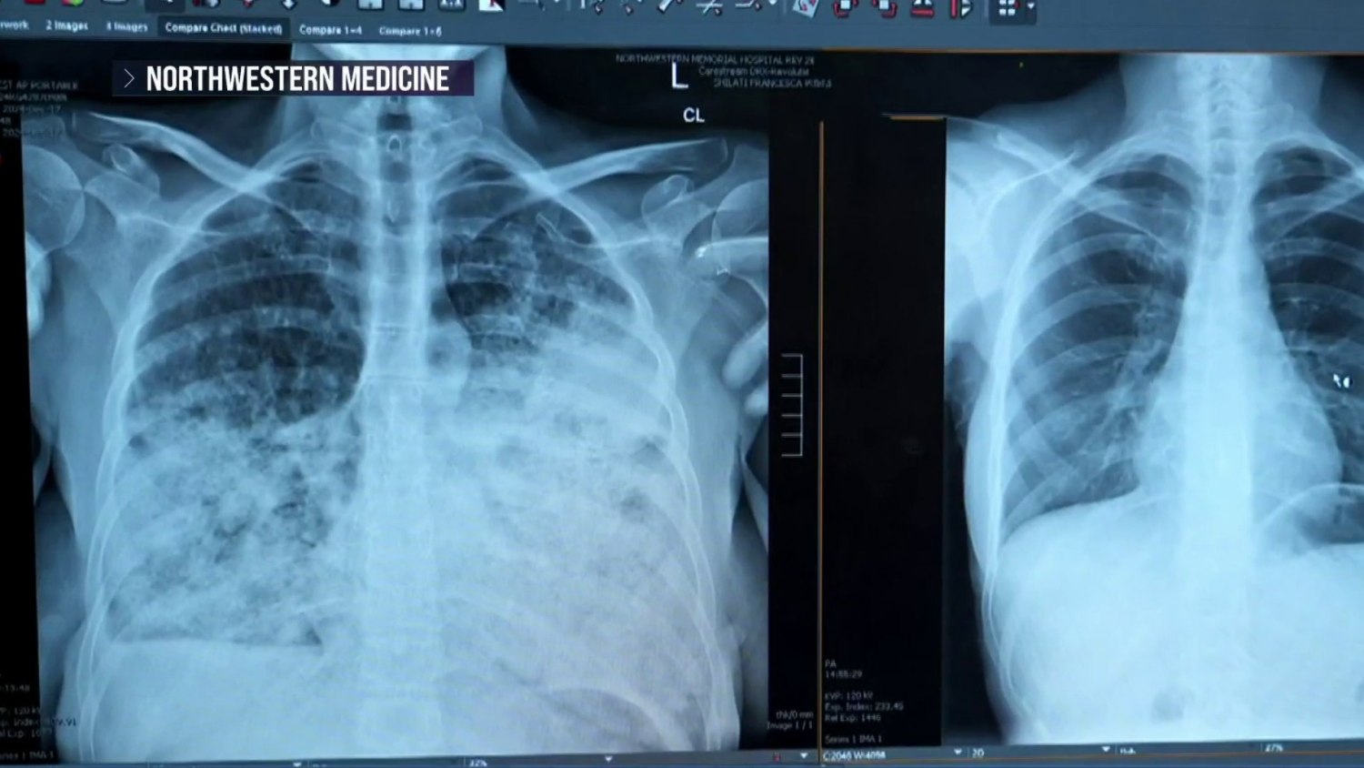 Chest X Ray Clear Lung Cancer