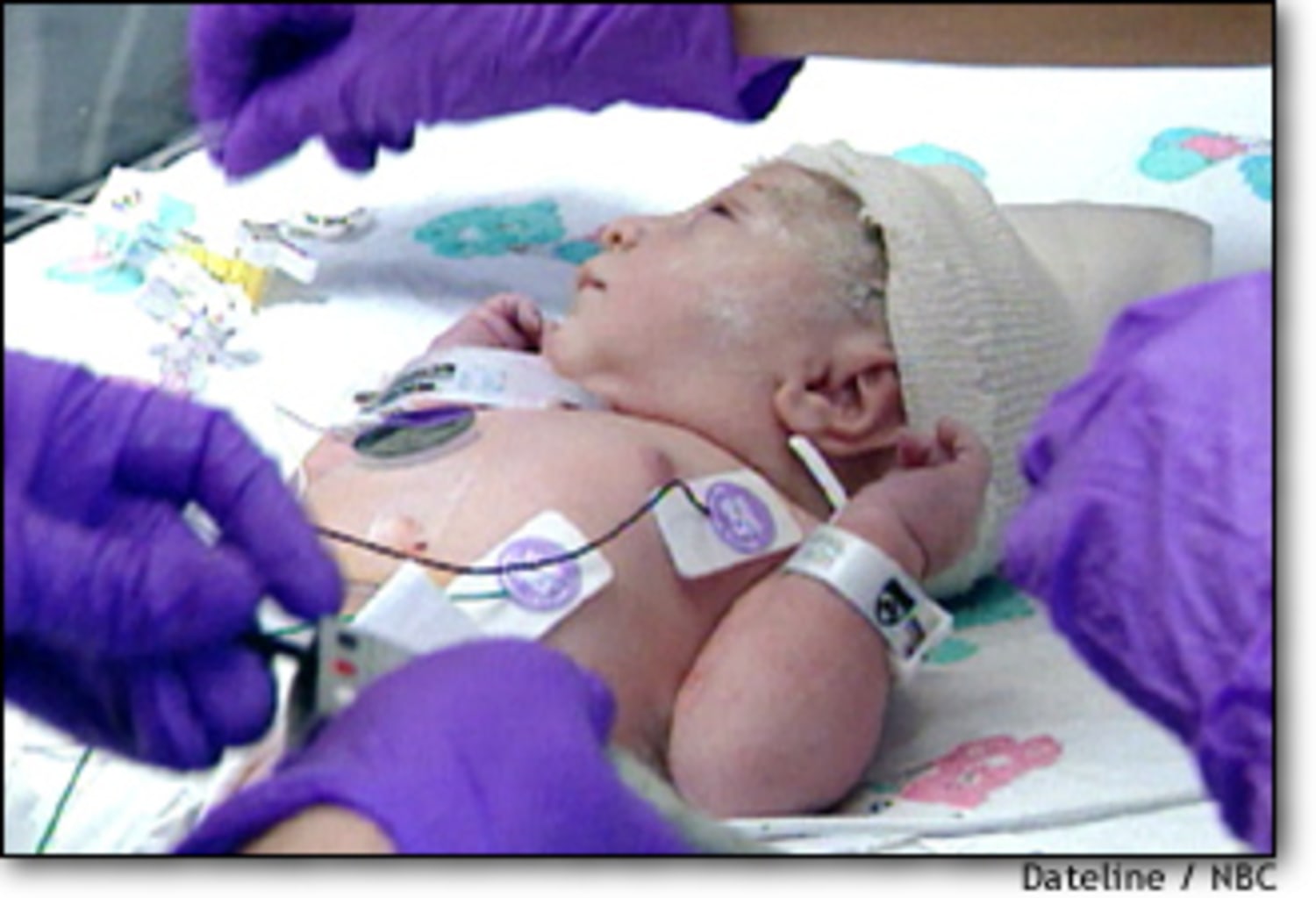 Brave girl was born with heart outside chest (Video)