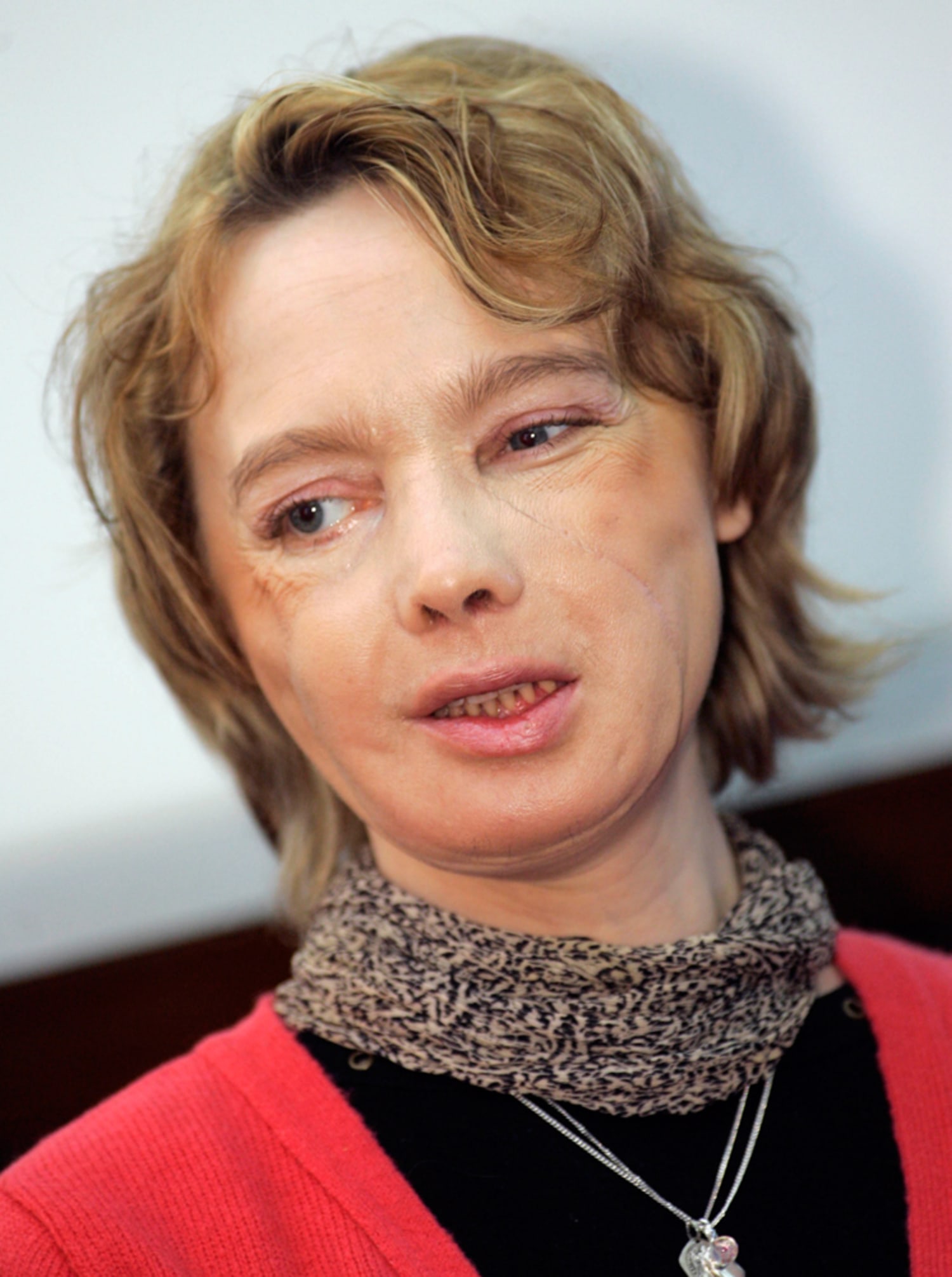 5 months later, face transplant has 'total feeling