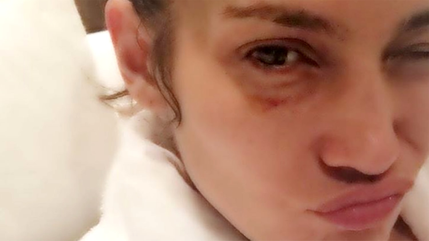 Ouch! Jennifer Lopez reveals black eye in photo, blames work