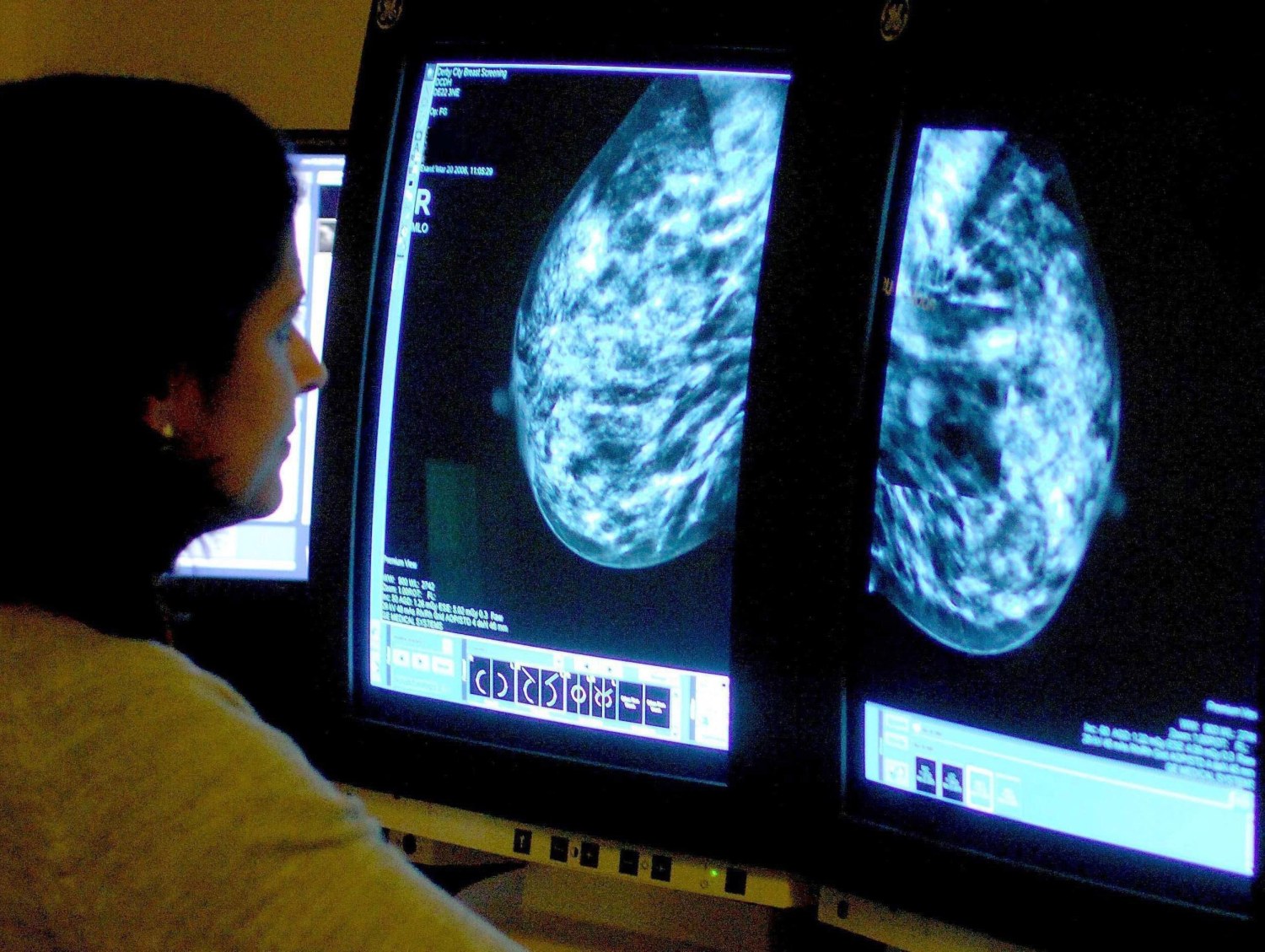 Completeness of breast surface map for the three scanning