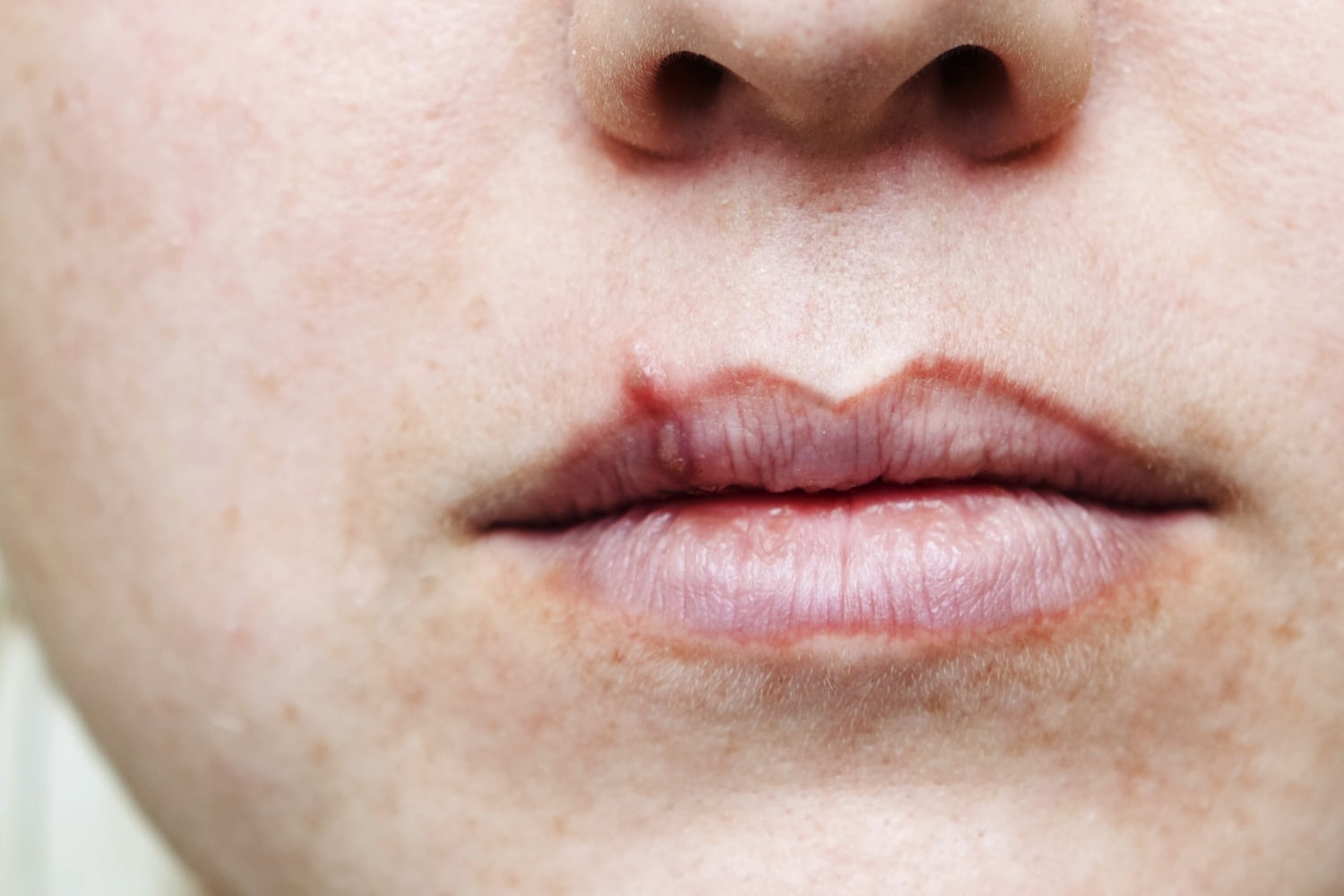 herpes-simplex-lips-symptoms-lipstutorial