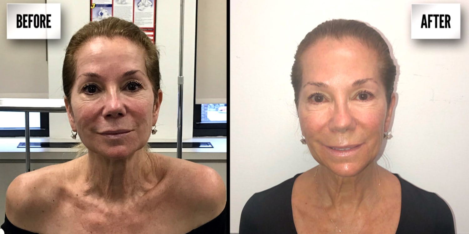 What is Ultherapy? Cost and review of the mini lift without surgery